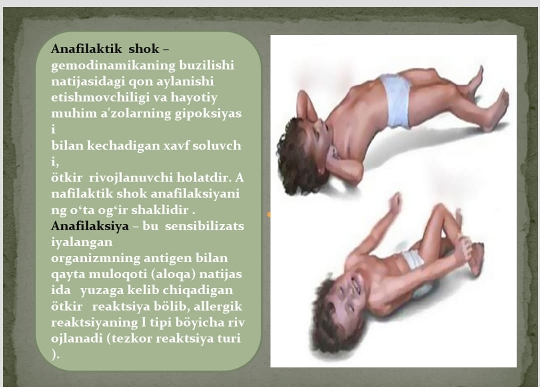 Anafilaktik  shok
