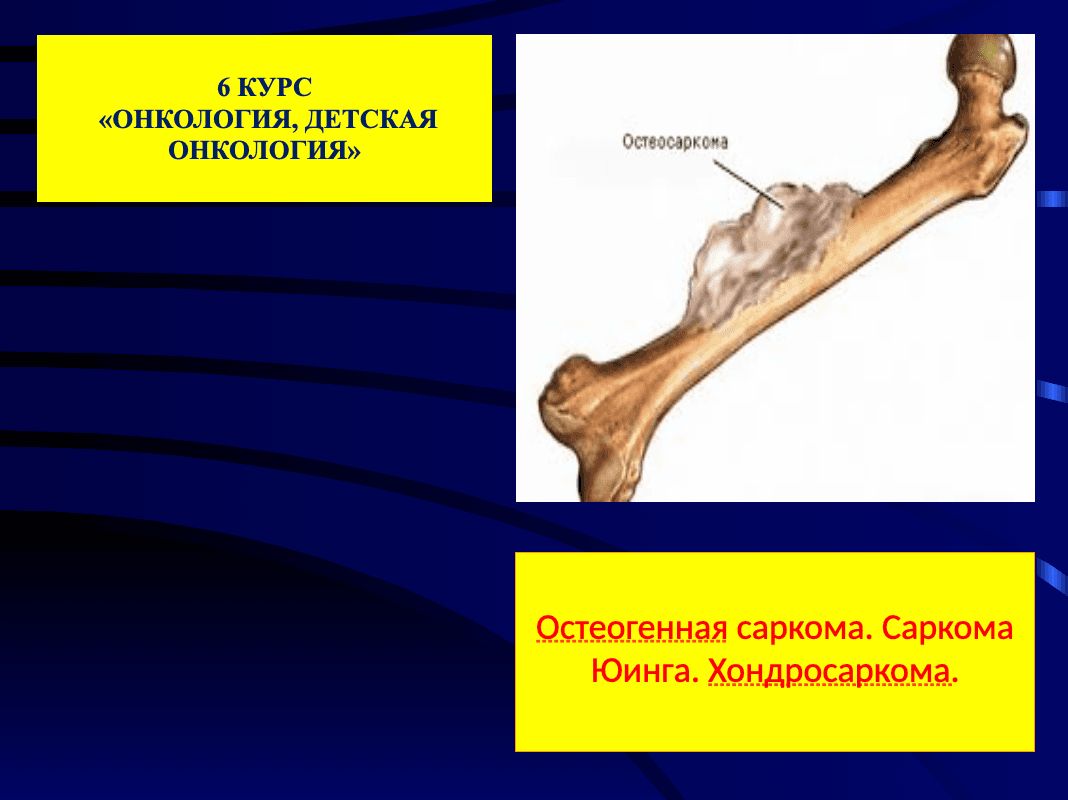 Остеогенная саркома. Саркома Юинга. Хондросаркома.ppt