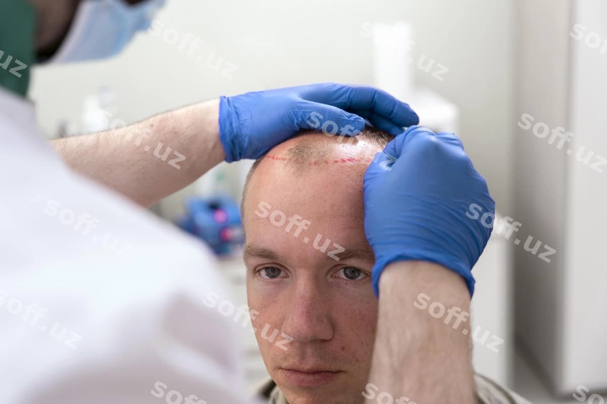 Katta erkak sochlarning ketish muammolari bor | Adult male having balding problems