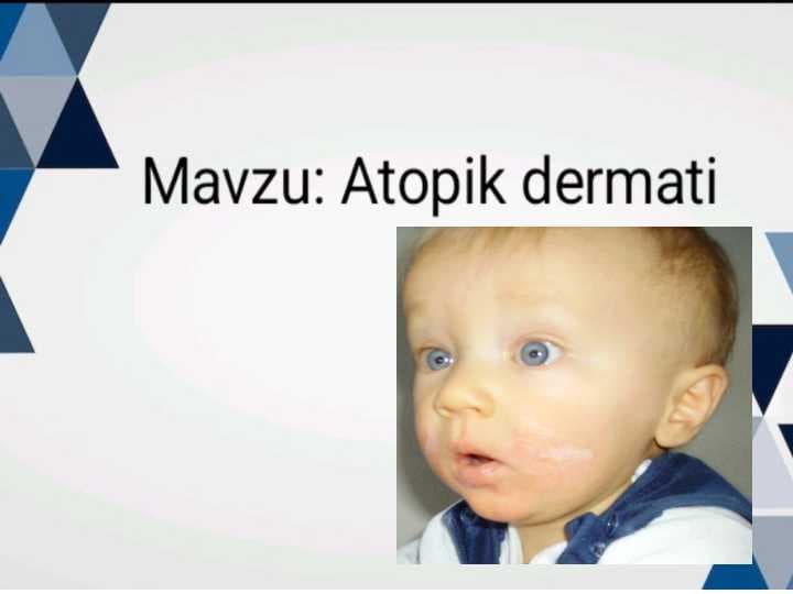 Atopik dermatit