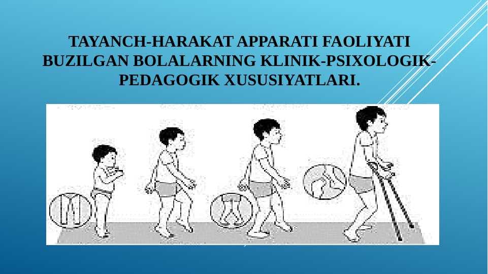 Tayanch-harakat apparati faoliyati buzilgan bolalarning klinik-psixologik-pedagogik xususiyatlari