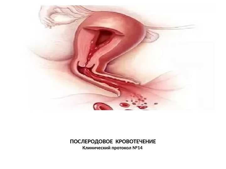 ПОСЛЕРОДОВОЕ КРОВОТЕЧЕНИЕ Клинический протокол №14