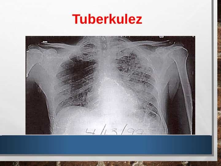Tuberkulez