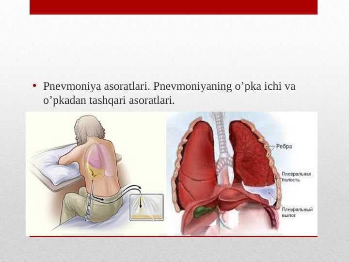 Pnevmoniya Asoratlari.Oʻpkadan tashqari va oʻpka ichi asoratlari