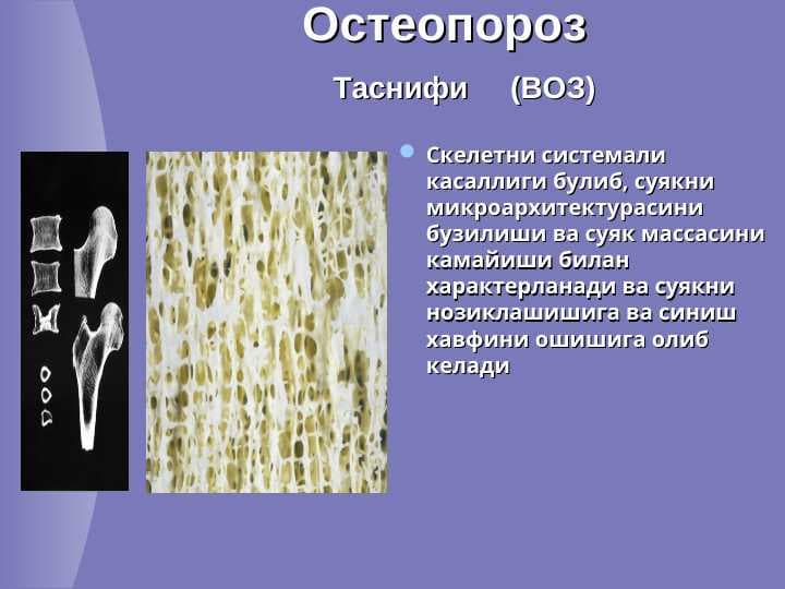 Остеопороз