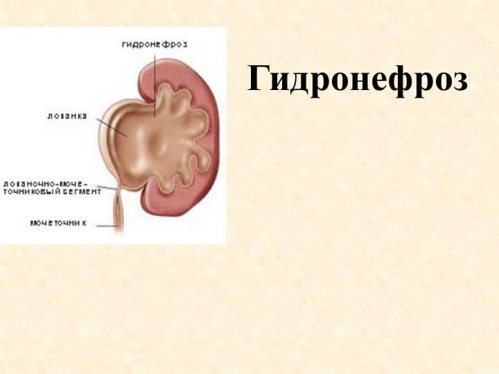 Buyrak tug`ma anomaliyalari.Gidronefroz patogenezi klinikasi etiologiyasi bolalar gidronefrozi