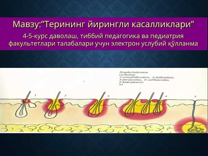 Терининг йирингли касалликлари