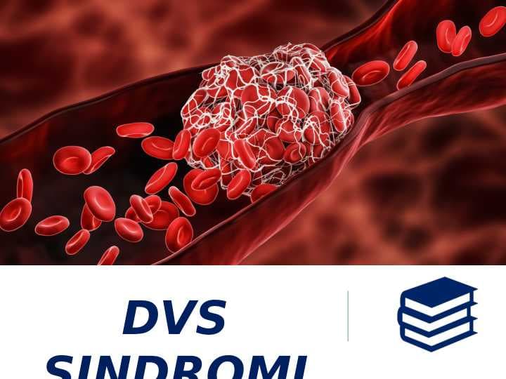 DVS SINDROMI