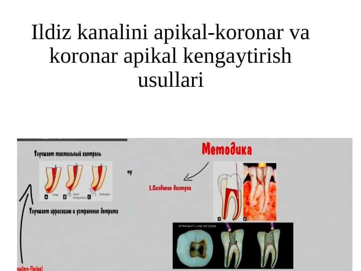Ildiz kanalini apikal-koronar va koronar apikal kengaytirish usullari