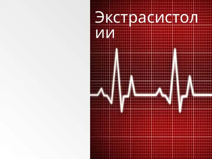 Экстрасистолии