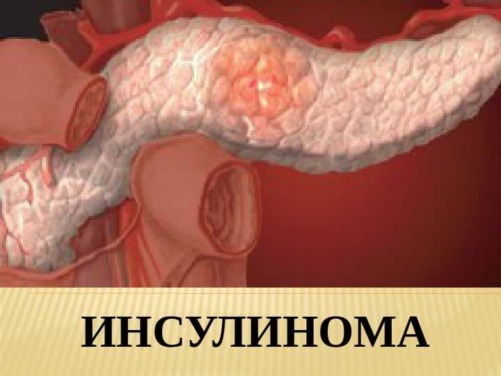 ИНСУЛИНОМА