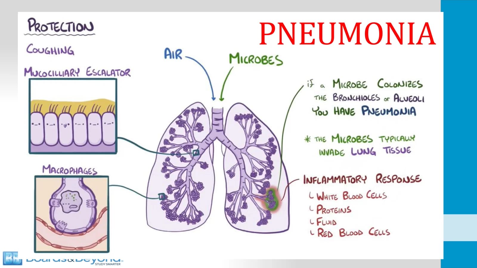 Lobar Pneumonia