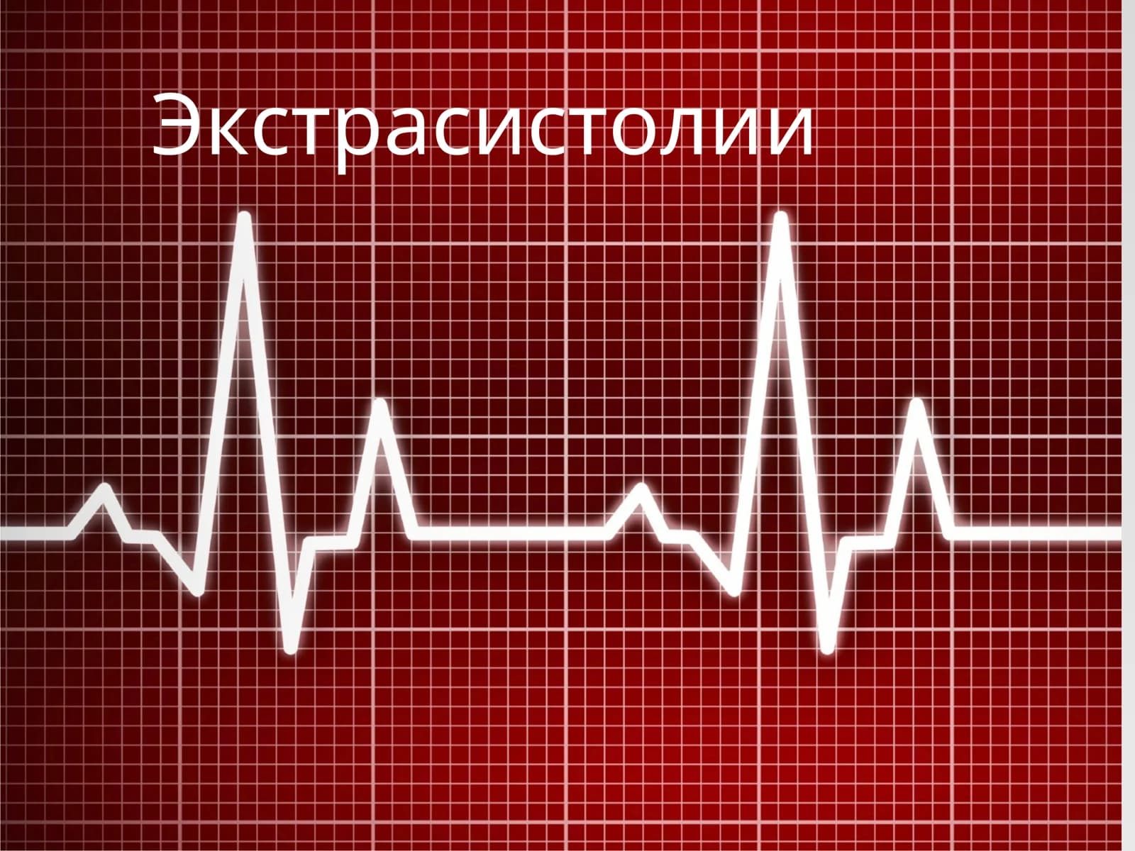Экстрасистолии