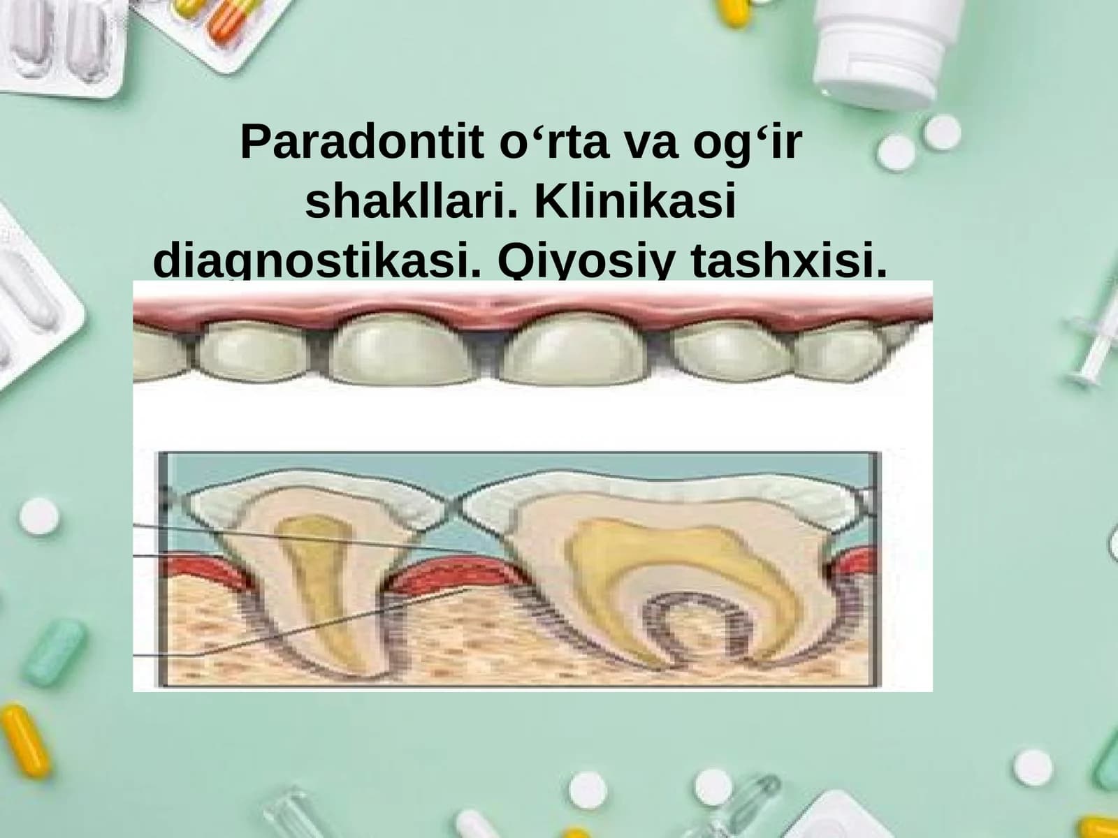 Paradontit