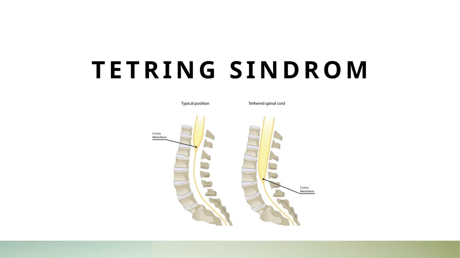 Tetring sindrom
