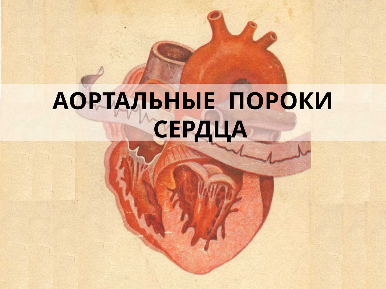 Недостаточность аортального клапана