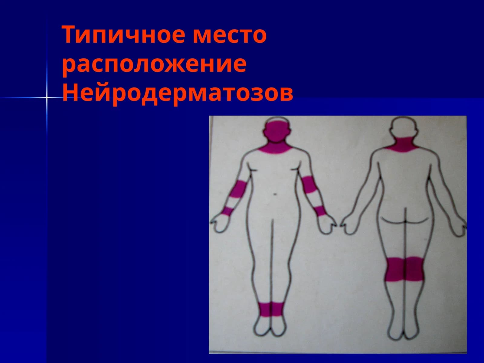 Нейродерматозов