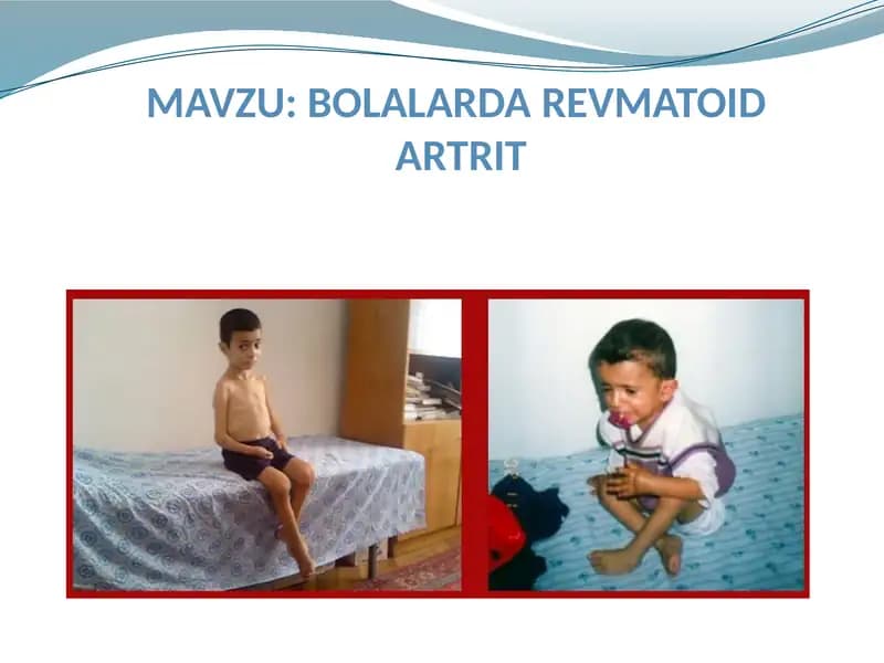Bolalarda Revmatoid Artrit