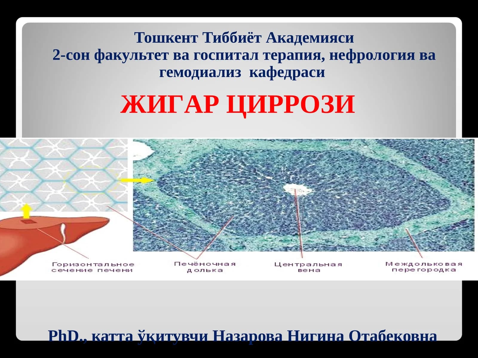 ЖИГАРЦИРРОЗИ
