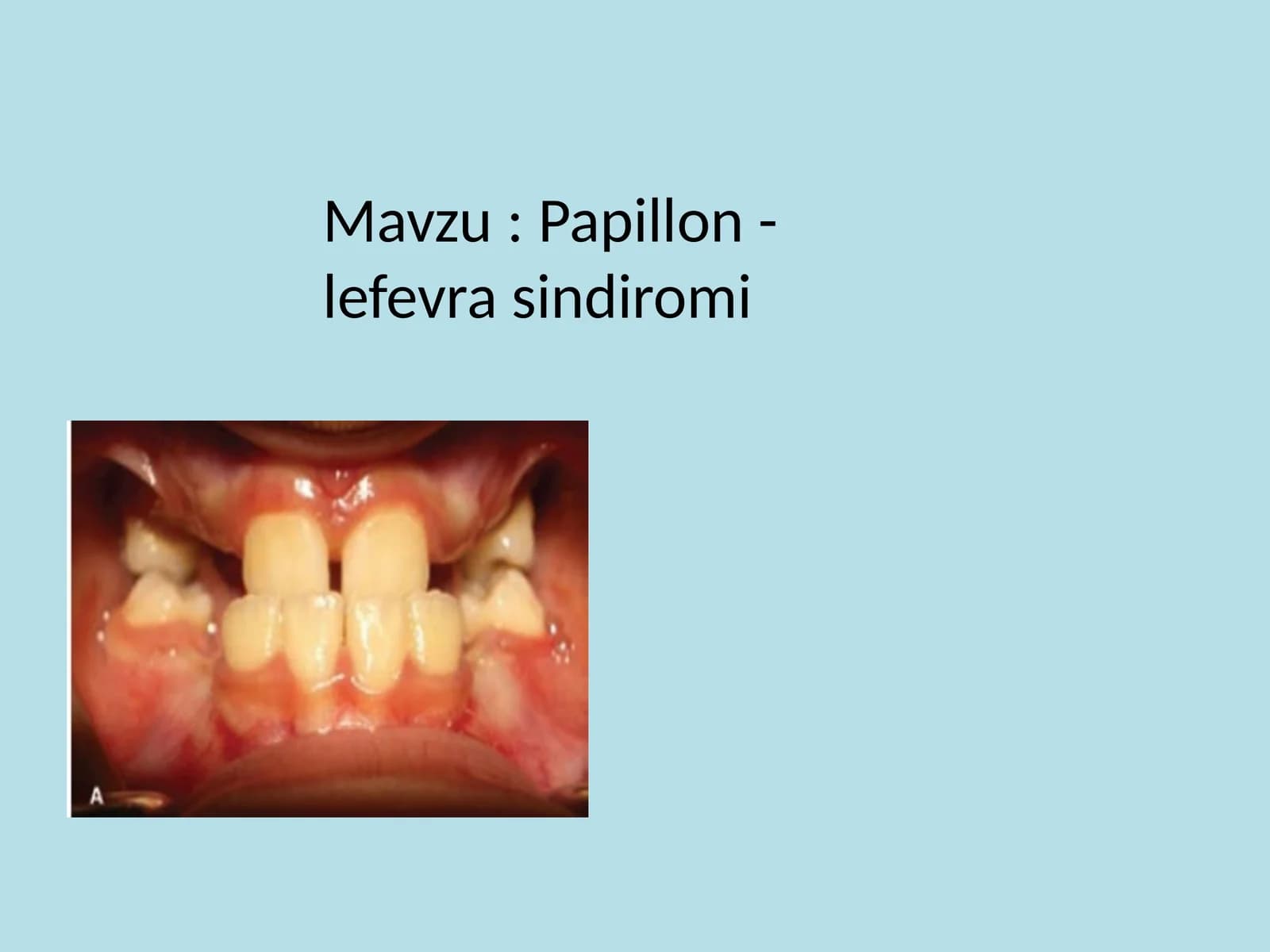 Papillon-Lefevre sindromi