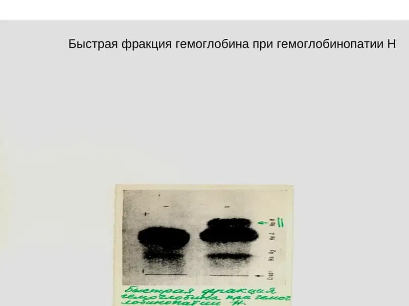 Генеологическая схема семьи с наследственной гемолитической анемией –β-талассемией