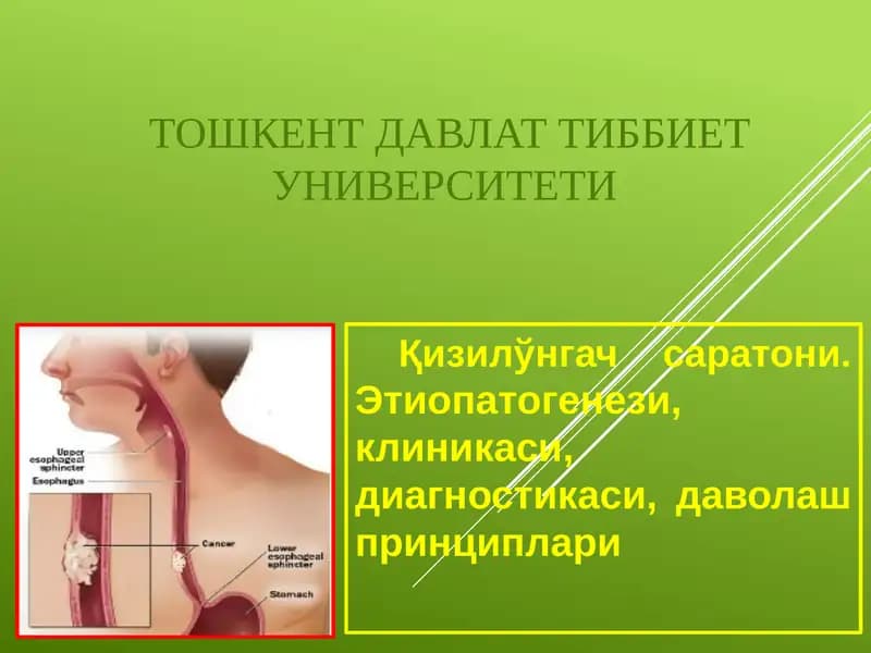 Қизилўнгач саратони.Этиопатогенези, клиникаси, диагностикаси, даволаш принциплари