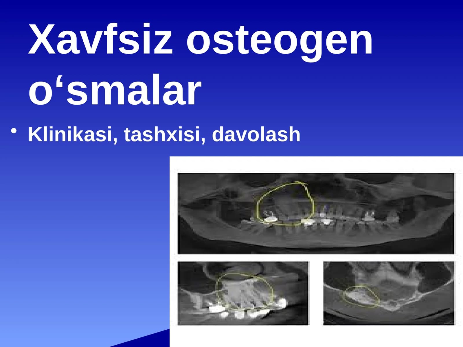 Xavfsiz osteogen o‘smalar