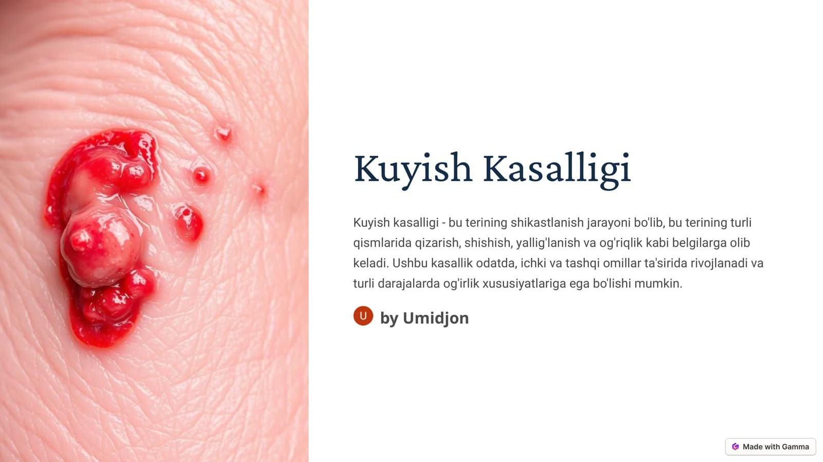 Kuyish kasaligi