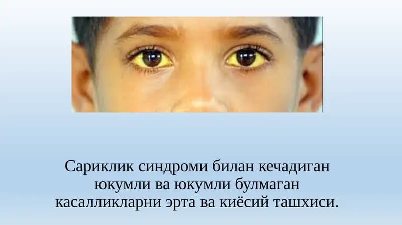 Сариклик синдроми