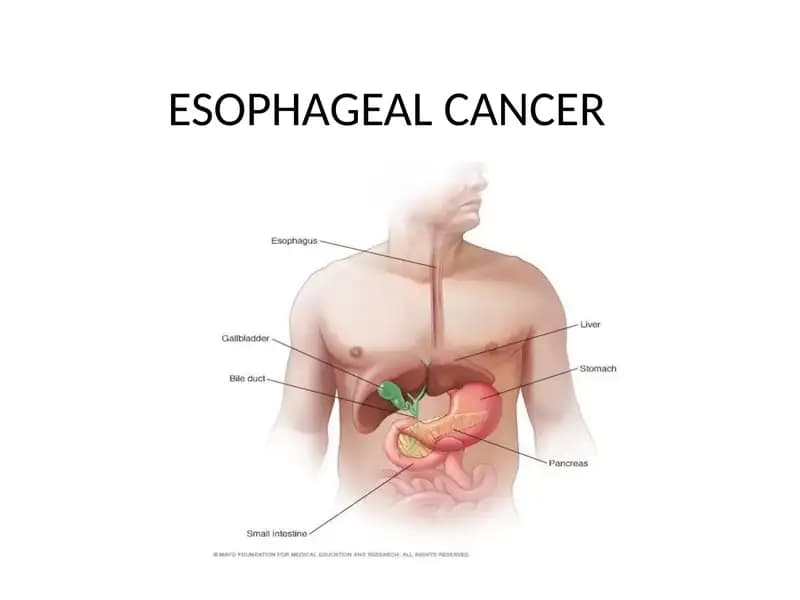 Esophageal Cancer