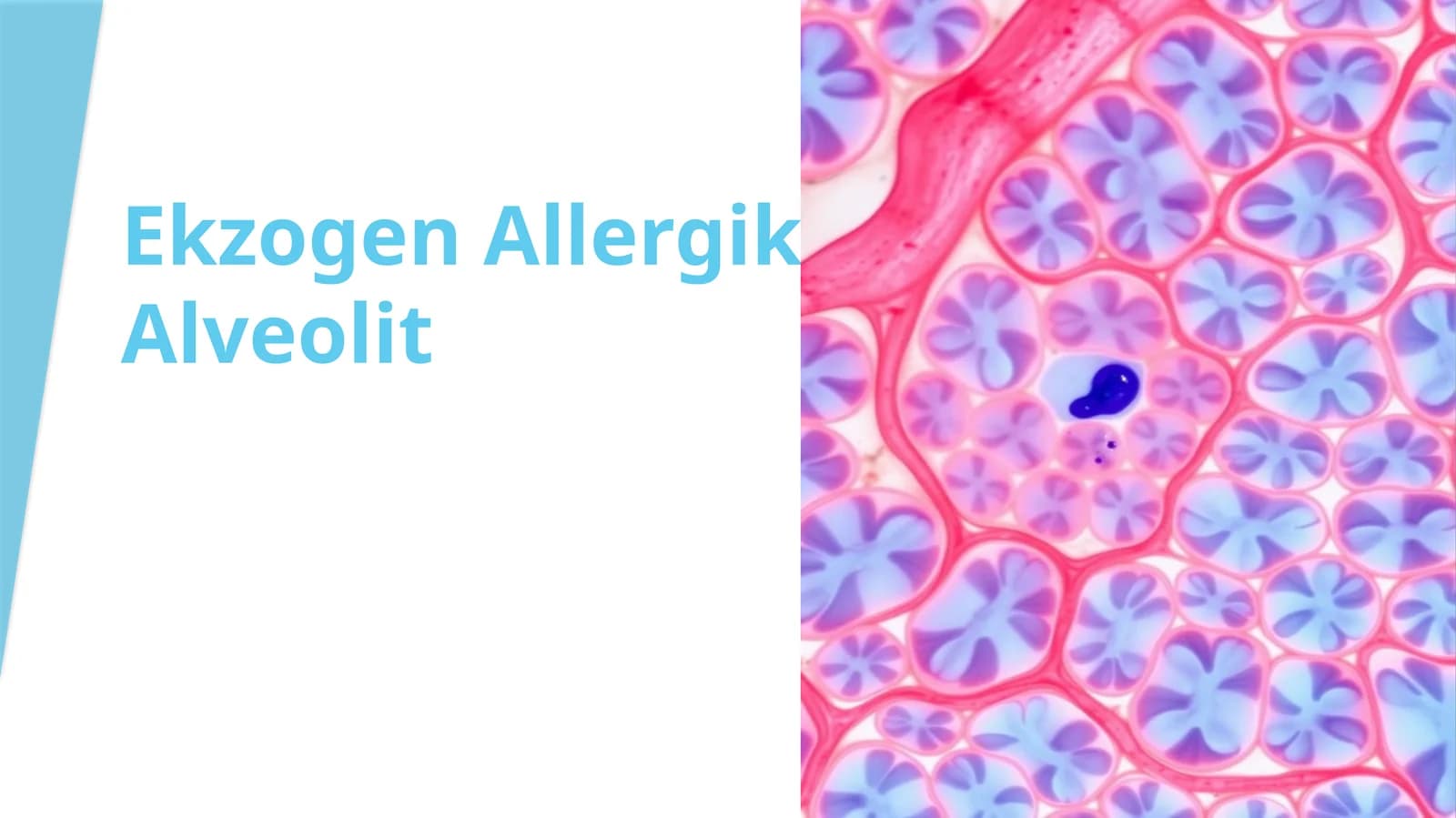 EkzogenAllergikAlveolit