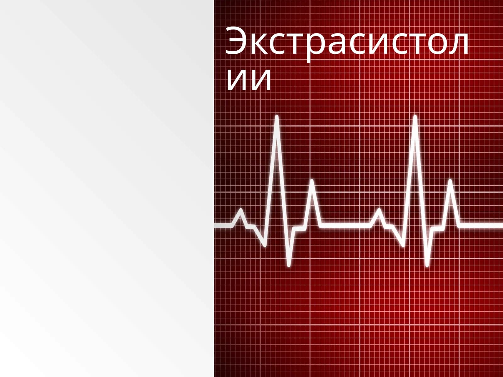 Экстрасистолия