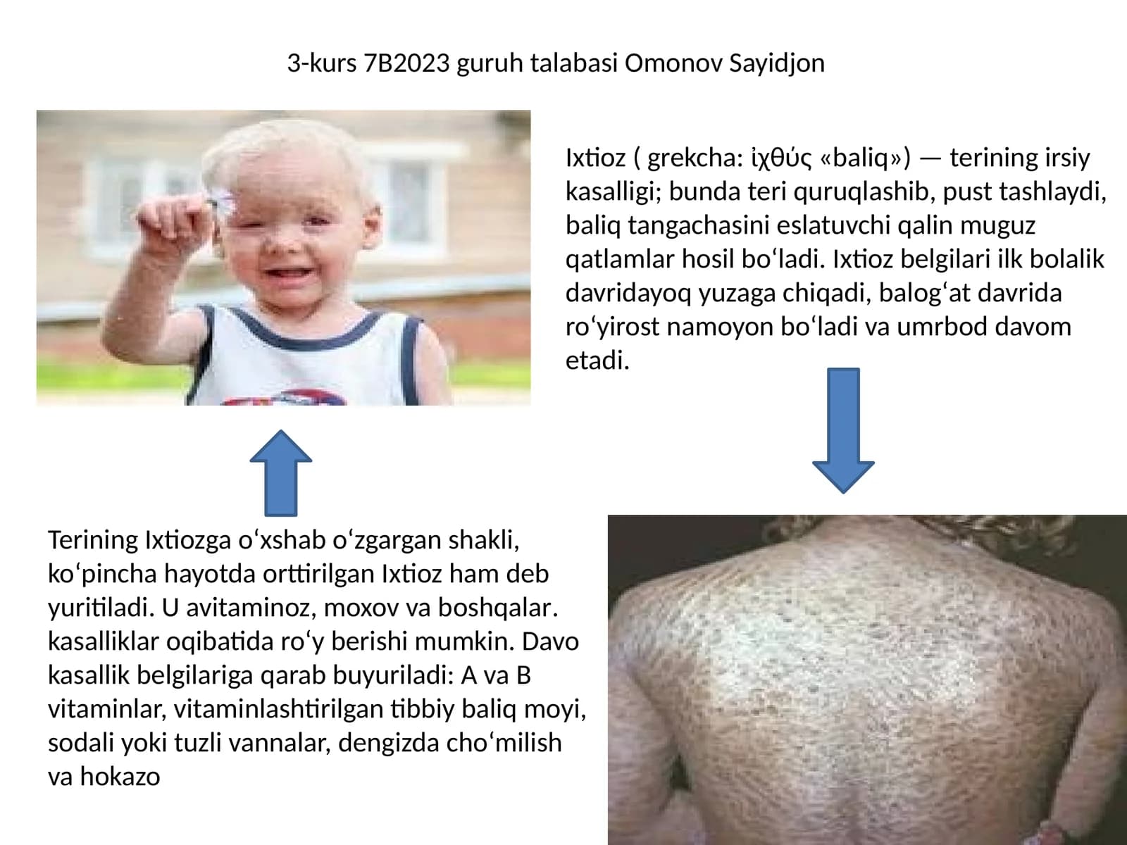 Ixtioz va gipertirixoz