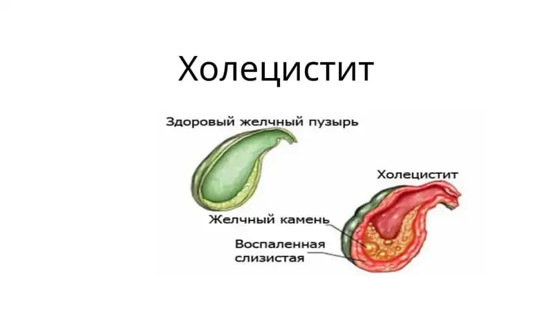 Холецистит