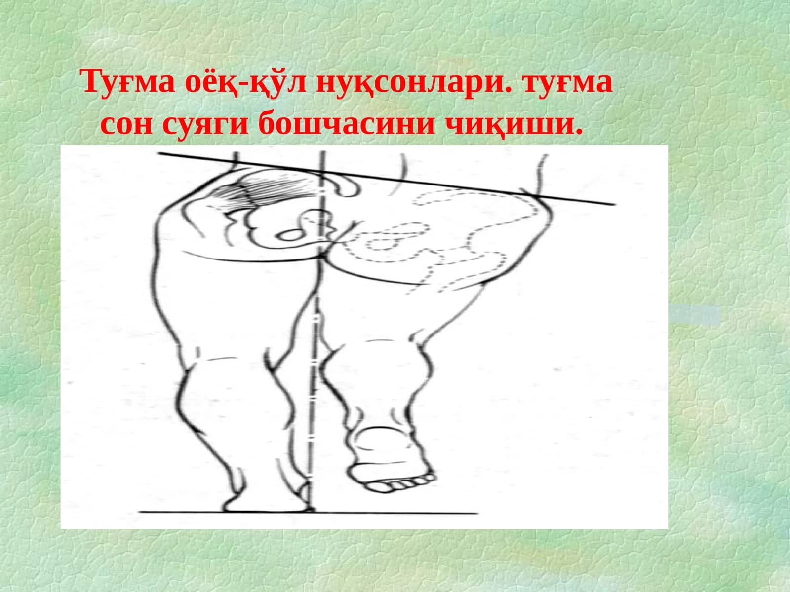 Симптом Барлоу