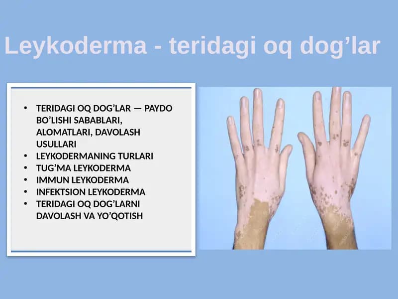 Leykoderma - teridagi oq dog’lar