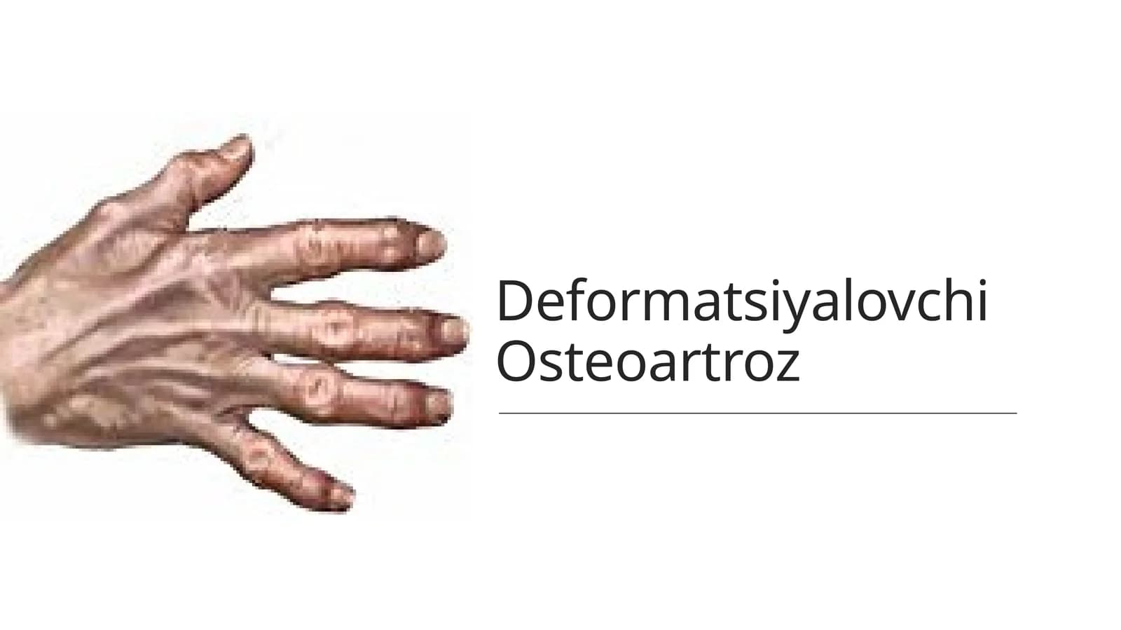 Deformatsiyalovchi Osteoartroz