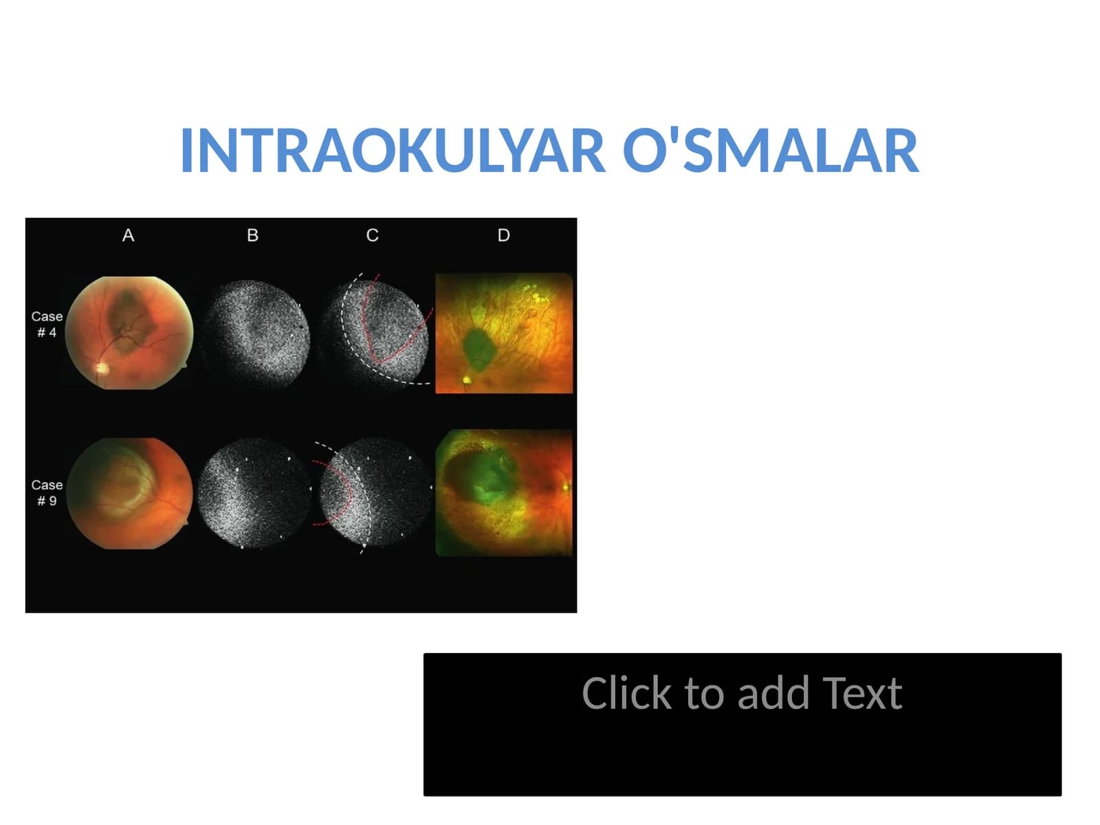 introkulyar o'smalar