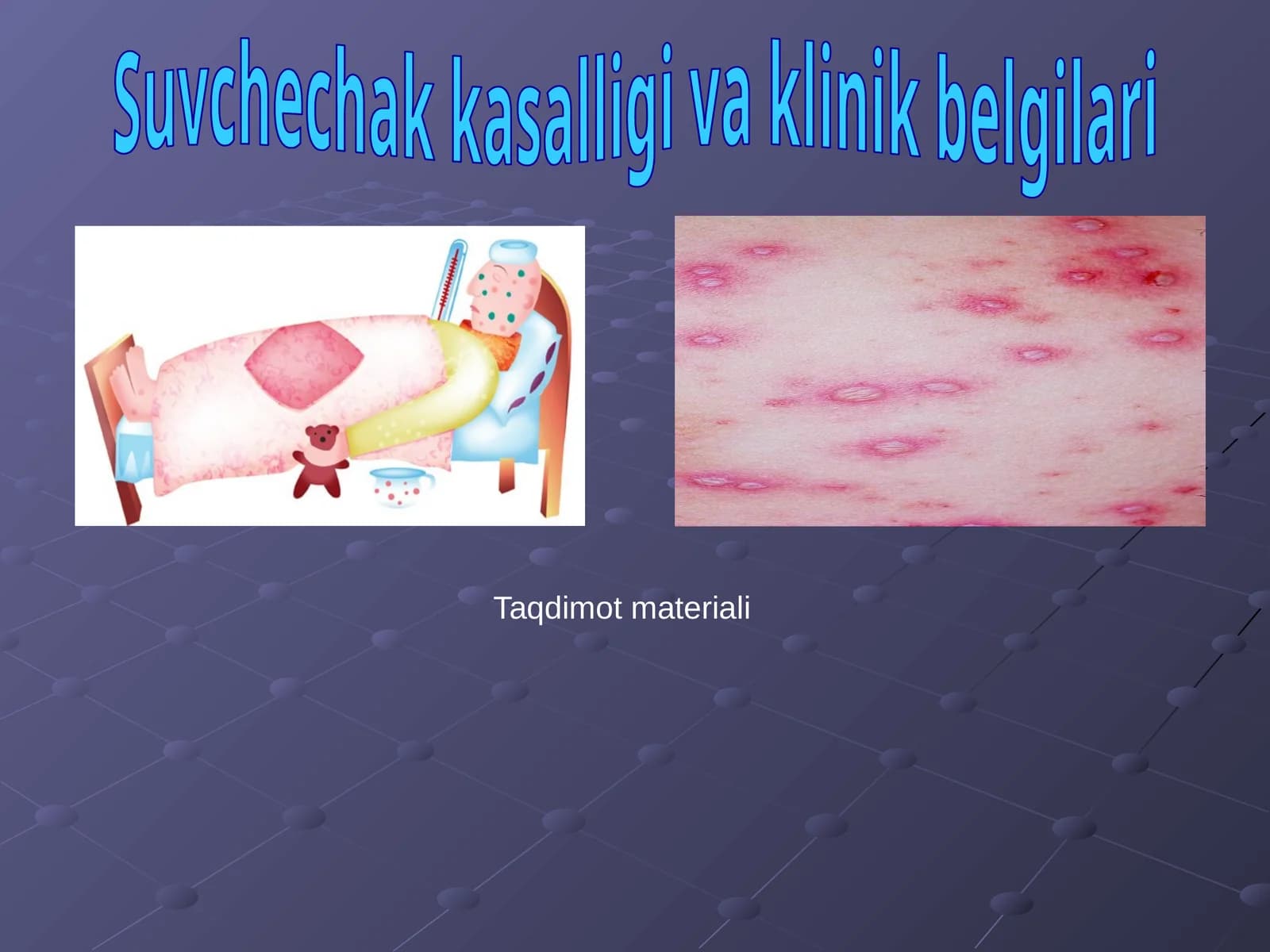 Suvchechak kasalligi va klinik belgilari