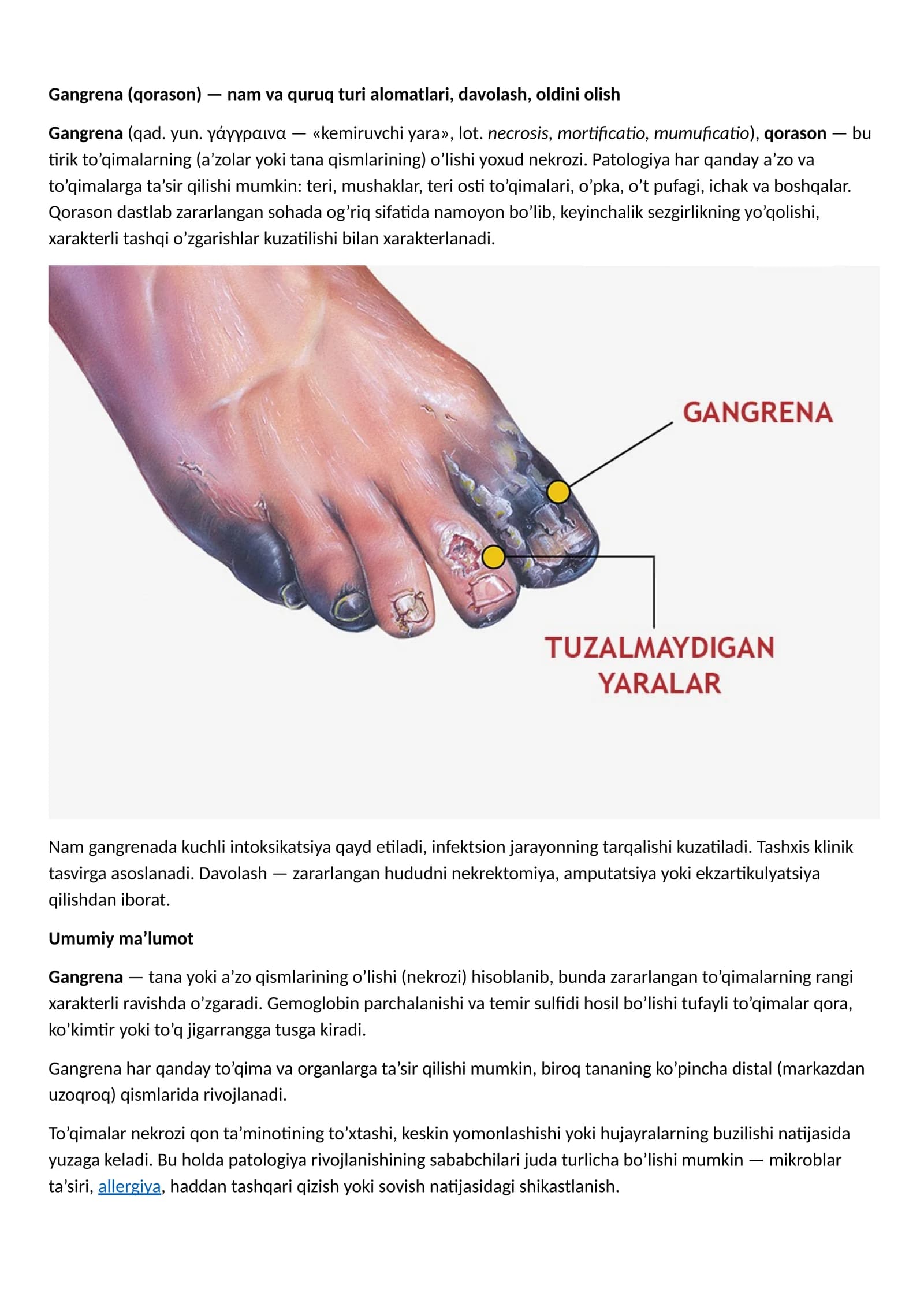 Gangrena (Qorason) Alomatlari va Davolash Usullari