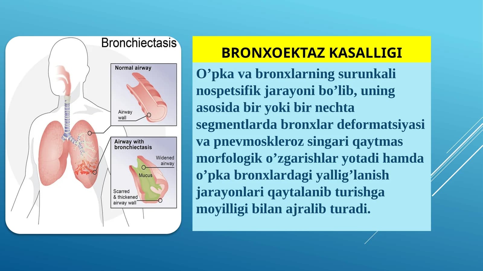 Bronxoektaz kasalligi