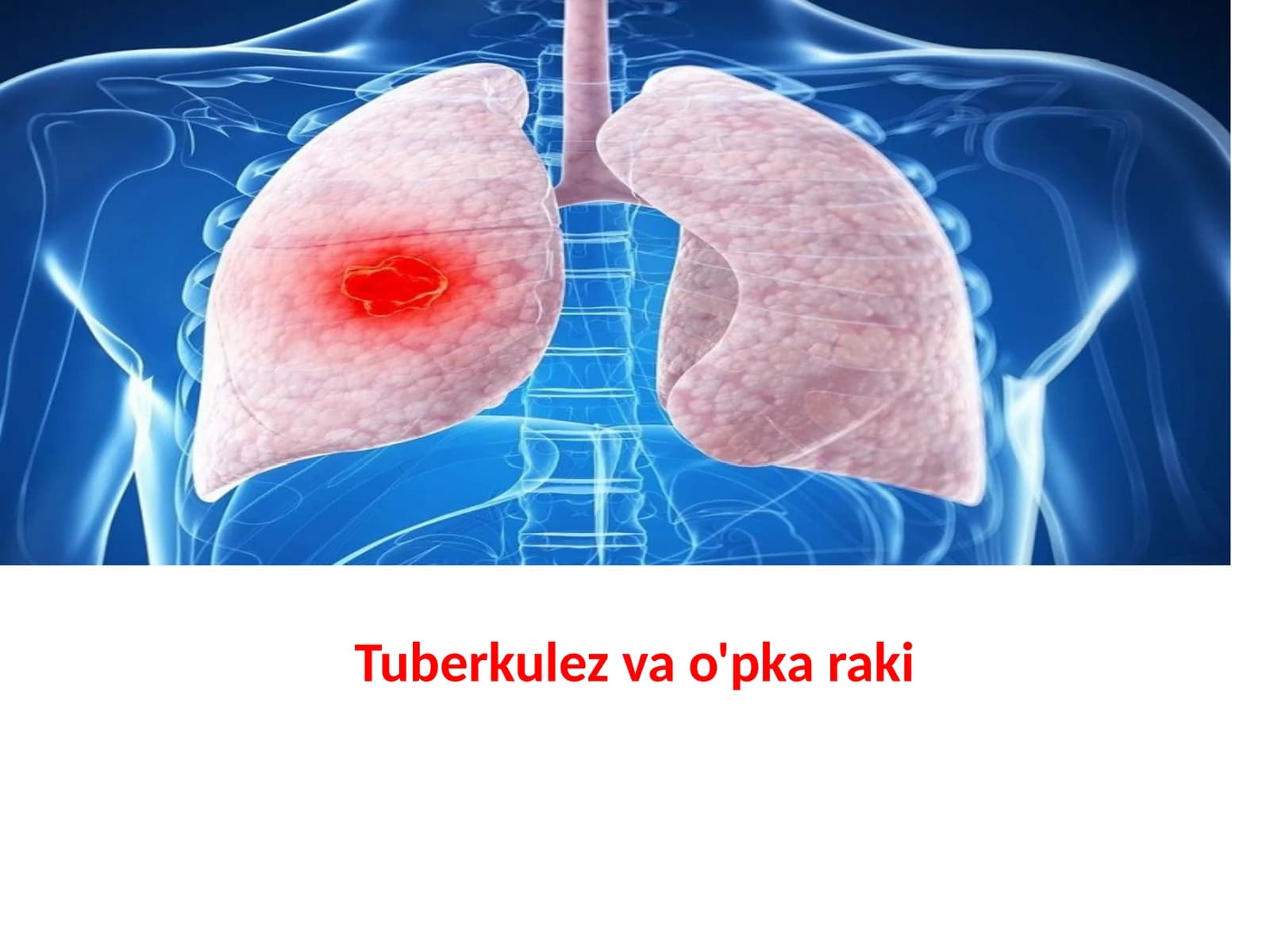 Tuberkulezvao'pkaraki