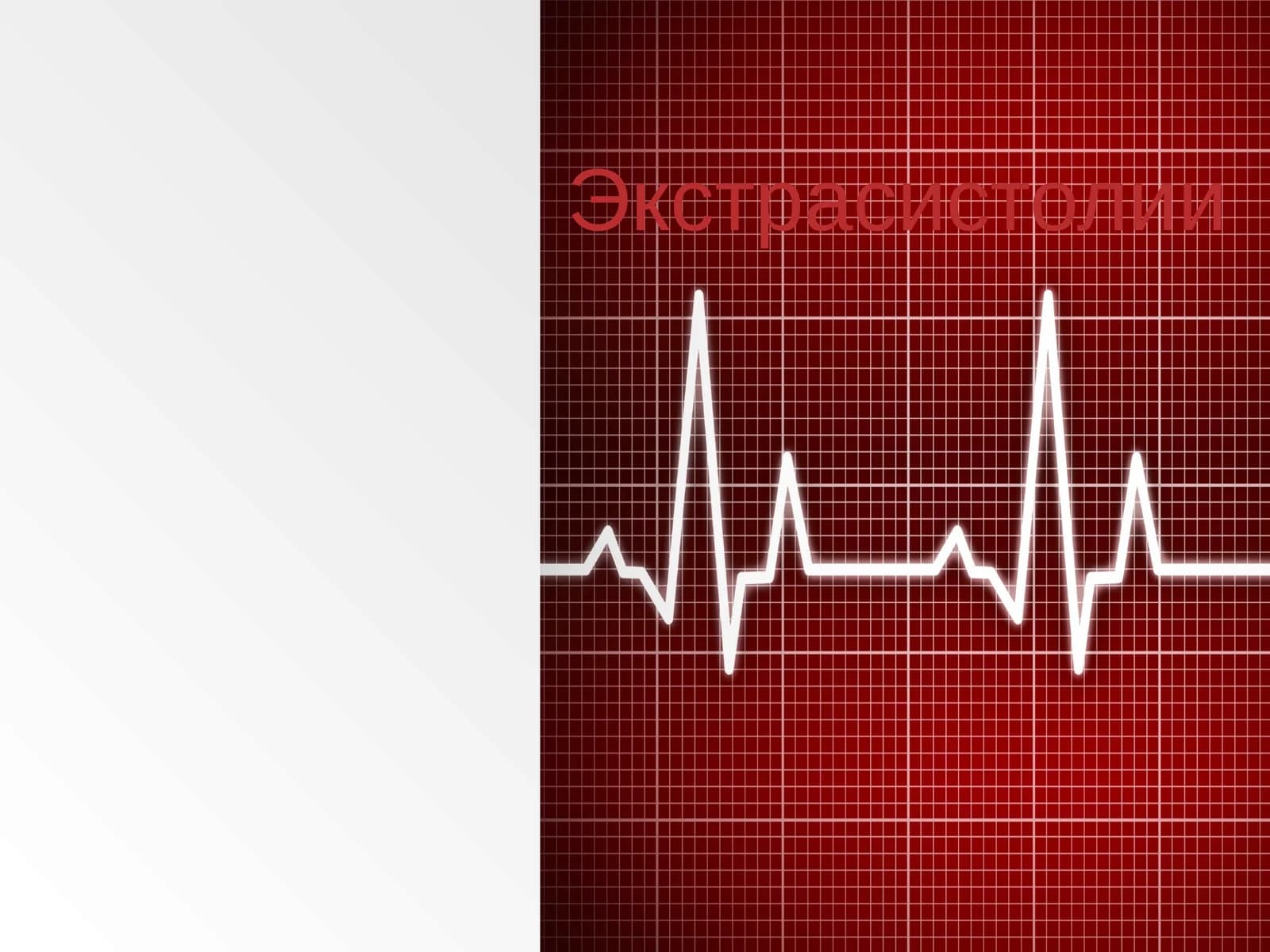 Экстрасистолии