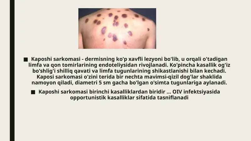 Kaposi sarkomasi