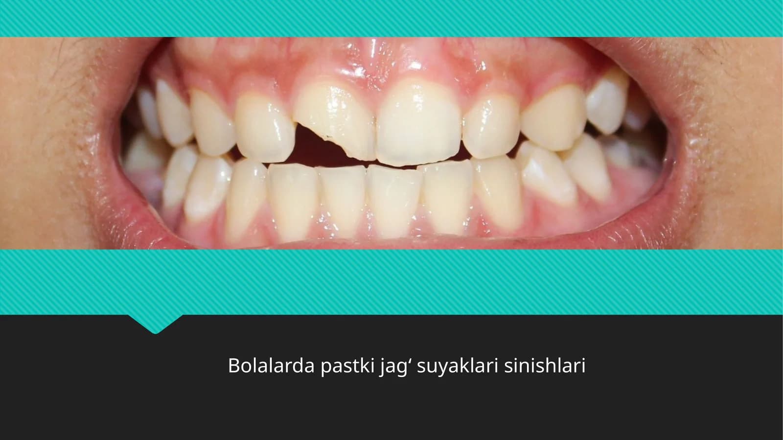 Bolalarda pastki jag‘suyaklari sinishlari