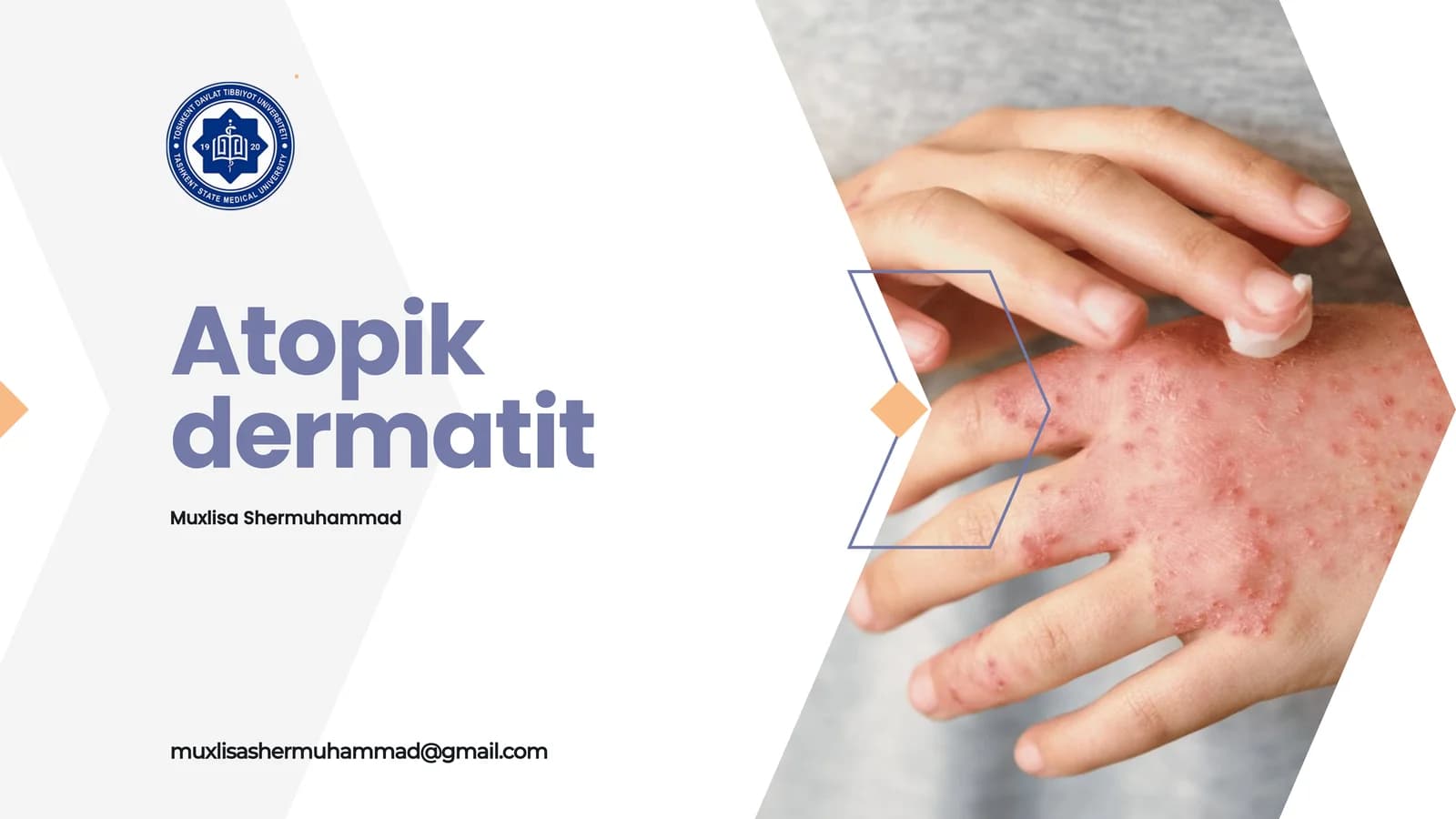 Atopik dermatit