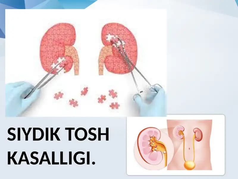 Siydik tosh kasalligi.