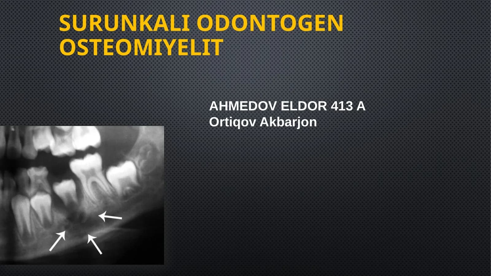 Surunkaliodontogenosteomiyelit
