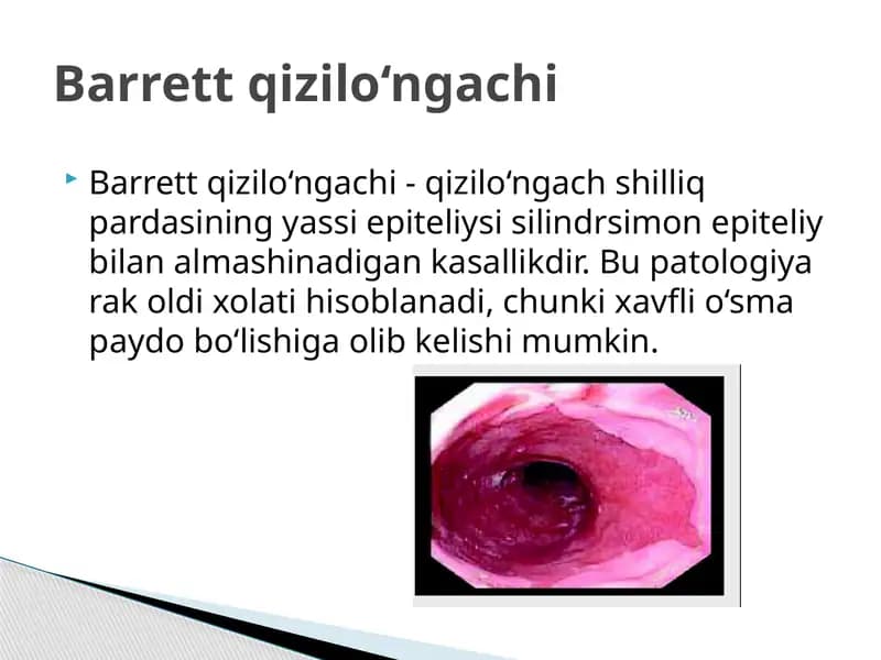 Barrett qizilo‘ngachi