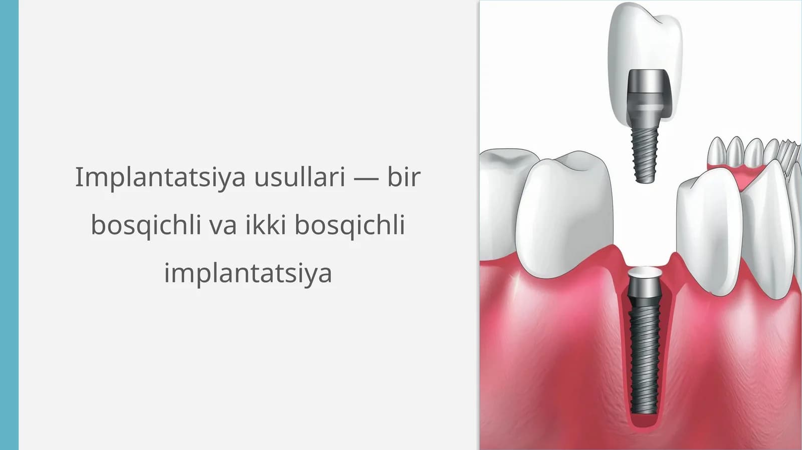 Implantatsiya usullari